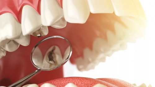 Часто задаваемые вопросы о кариесе